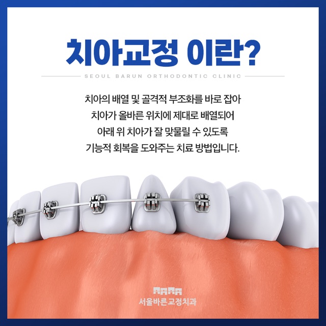 덕천치아교정 장치를 고를 때, 비용 말고 먼저 볼 조건들